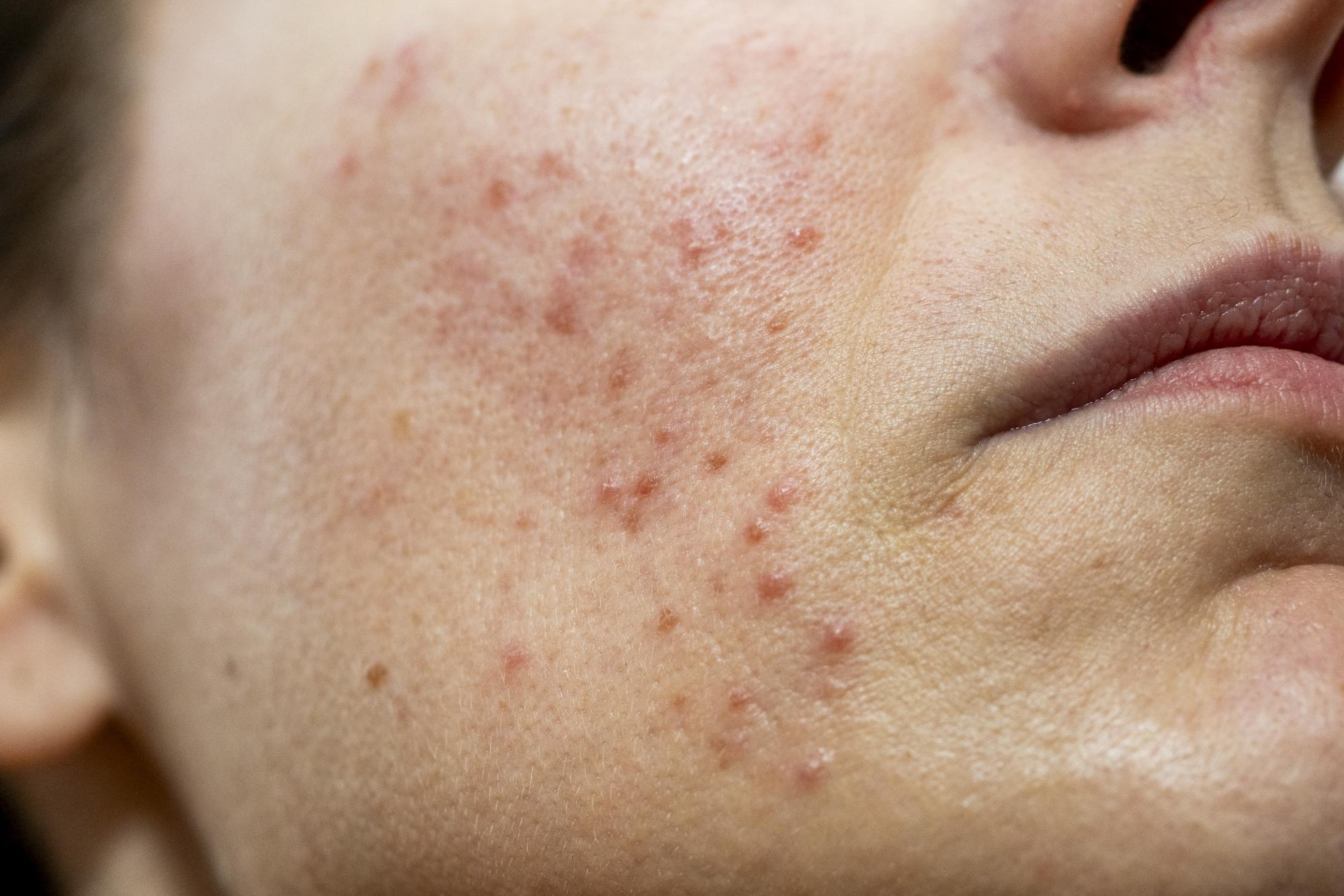 Acne at every age with causes and dermatologist tips for proper care
